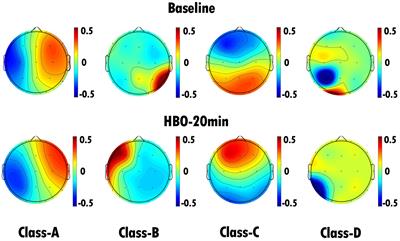 EEG microstate changes during hyperbaric oxygen therapy in patients with chronic disorders of consciousness